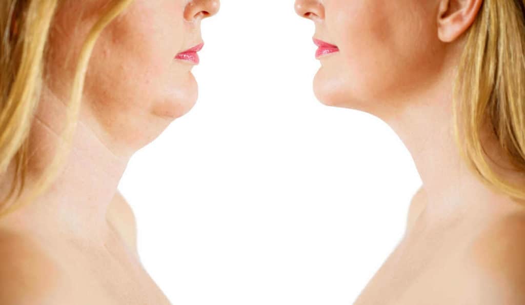 Double Chin treatment Mansfield before and after results