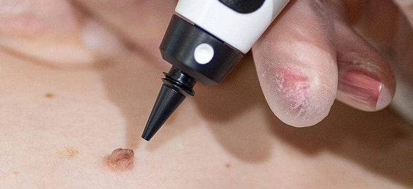 After Skin Tag Removal Mansfield