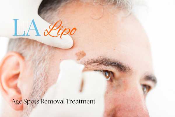 What Are the Most Effective Treatments for Age Spots Mansfield?