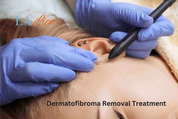 Dermatofibroma Removal Treatment Mansfield