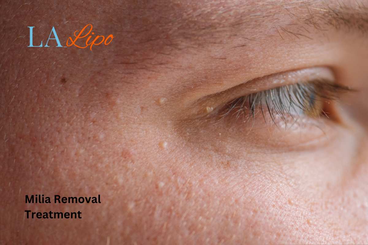 Cryopen Milia Removal: Is It the Easiest and Safest Option Mansfield?