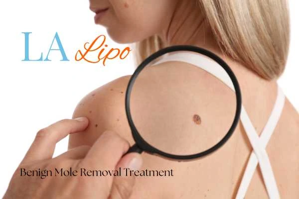 Woman having her inspection of blemish before mole removal Mansfield