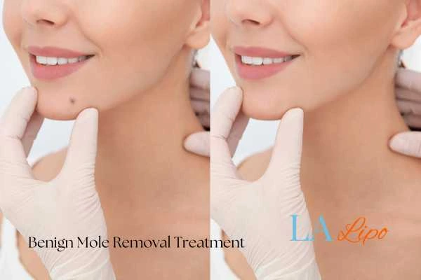 Before and after mole removal Mansfield treatment