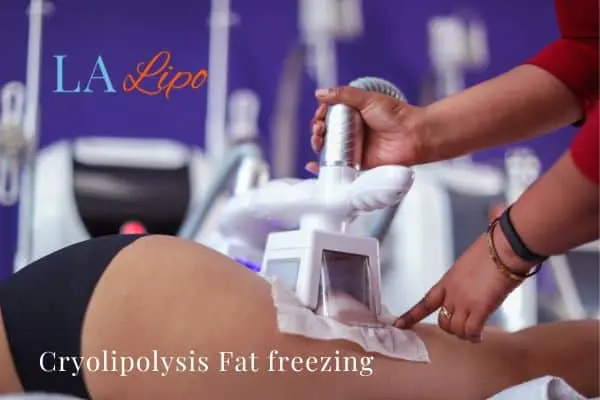 women getting fat freezing Mansfield