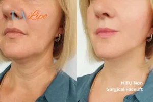 hi-fu for wrinkles Mansfield before and after results