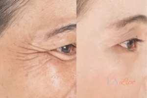 Before and after results of woman - HI-fu wrinkles reduction treatment Mansfield