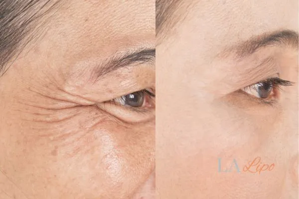 Before and after results of woman - HI-fu wrinkles reduction treatment Mansfield