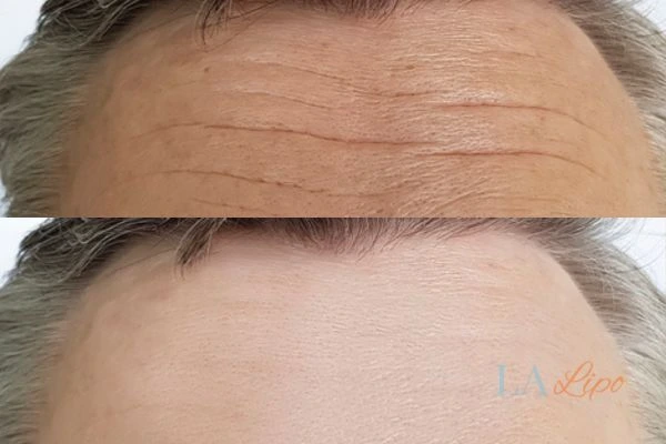 results of HIFU Mansfield on mans forehead to help reduce lines and wrinkles