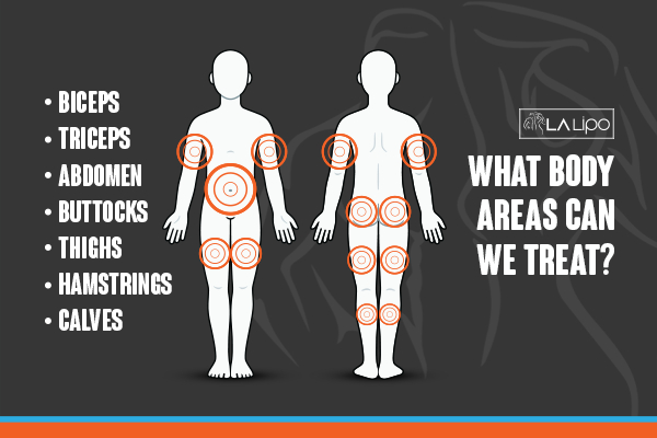 Graphic to show areas you can have LA-EMS Body Sculpting Mansfield treatment.