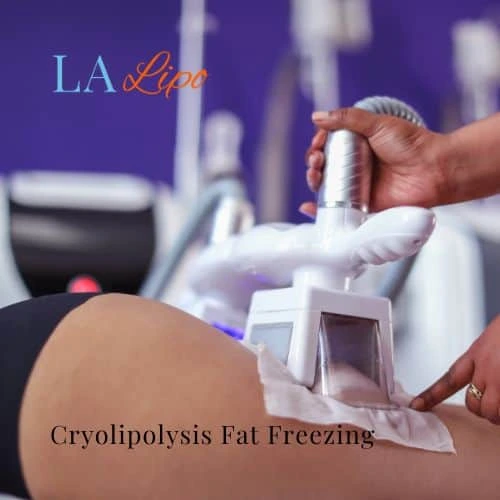 fat freezing - Cryolipolysis Mansfield