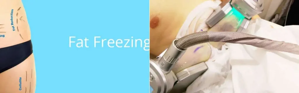 multi areas of a persons body having coolsculpting Mansfield treatment