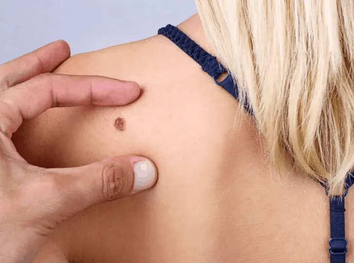 woman having mole removal Mansfield consultation before treatment.