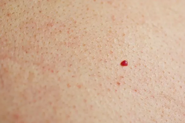 close up of a cherry angioma Mansfield