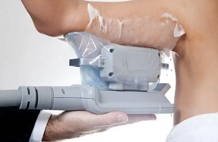 Picture of fat freezing Mansfield on the upper arms.