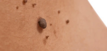 image of a skin tag Mansfield