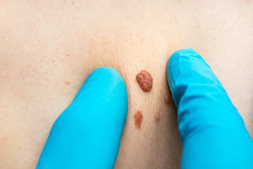 Consultant examining a skin tag Mansfield
