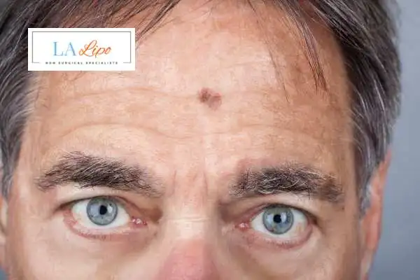 Solar Lentigo Removal Mansfield image of man with mark on his forehead