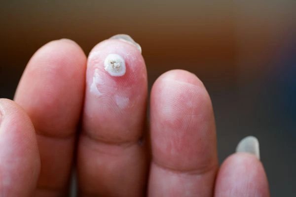 wart on person finger - cryotherapy to treat from LA LIPO Mansfield