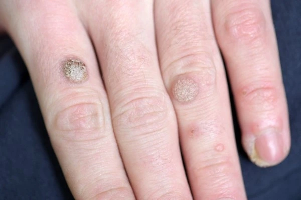 photo of warts on person hand - see wart removal Mansfield from LA LIPO