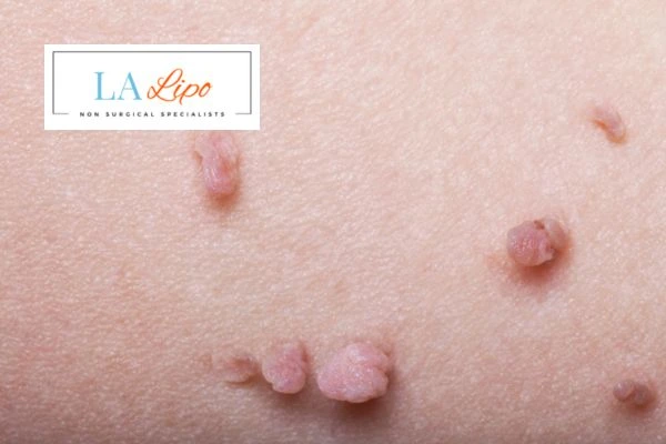 Does cryopen skin tag removal Mansfield hurt? Find out now call our team today!