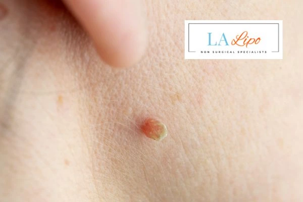 Book skin tag removal Mansfield today speak to our team now!