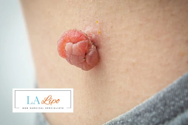 Interested in skin tag removal Mansfield? Concerned about the pain? Find out more today!