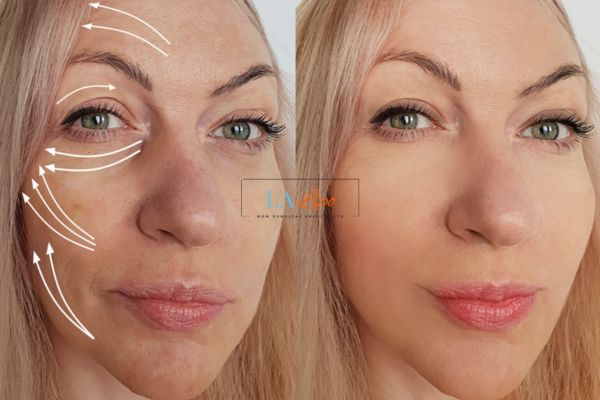 Morpheus 8 results Mansfield face lift.