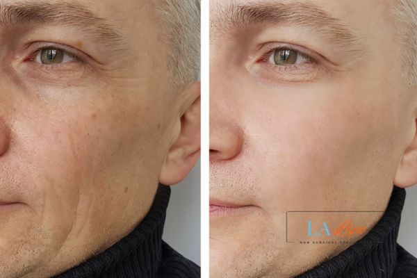 See the amazing results of Morpheus8 Treatment Mansfield!