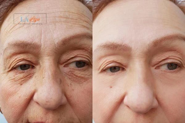 The powerful benefits of Morpheus8 Treatment Mansfield - Call Our team today!