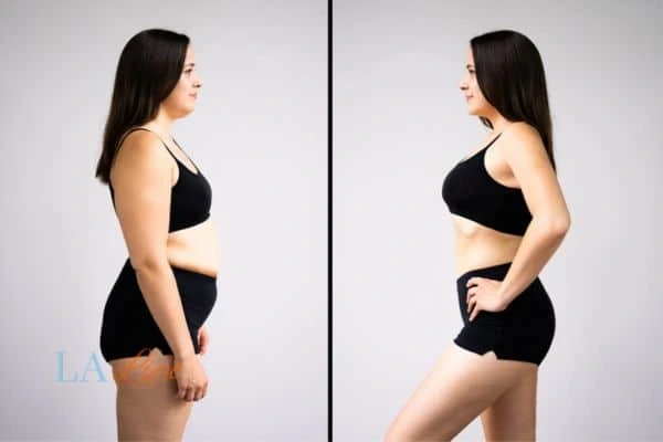 Picture of womans before and after using LA-EMS body sculpting to improve her core strength Mansfield