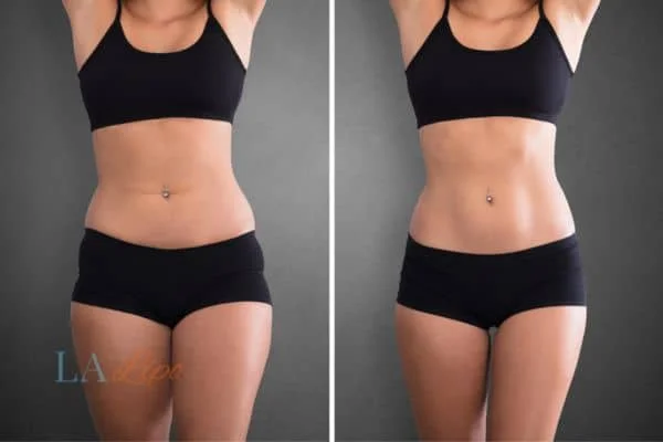 before and after results of non-surgical treatment to help a woman's body image and mental health Mansfield