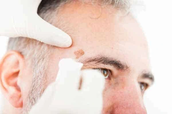 Age spots and elderly people Mansfield what is the link?