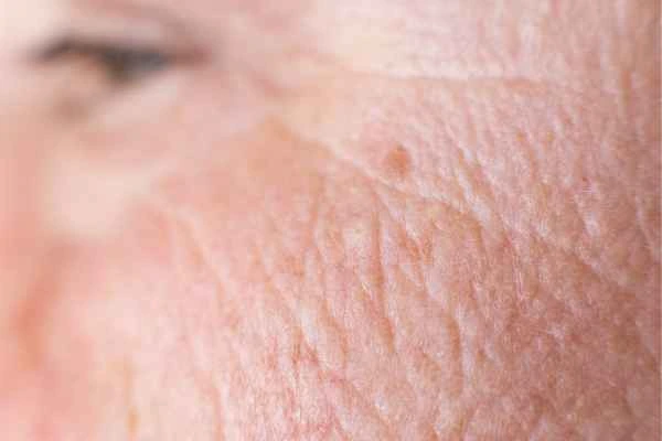 close up picture of a woman's face showing an age spot Mansfield