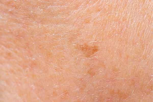close up picture of age spots Mansfield