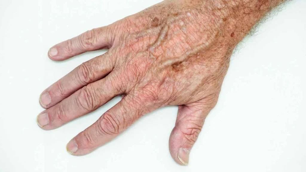 Male hand showing age spot Mansfield