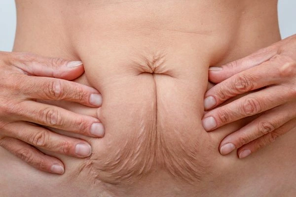 Image of a woman's stomach with loose skin - example of skin tightening Mansfield options