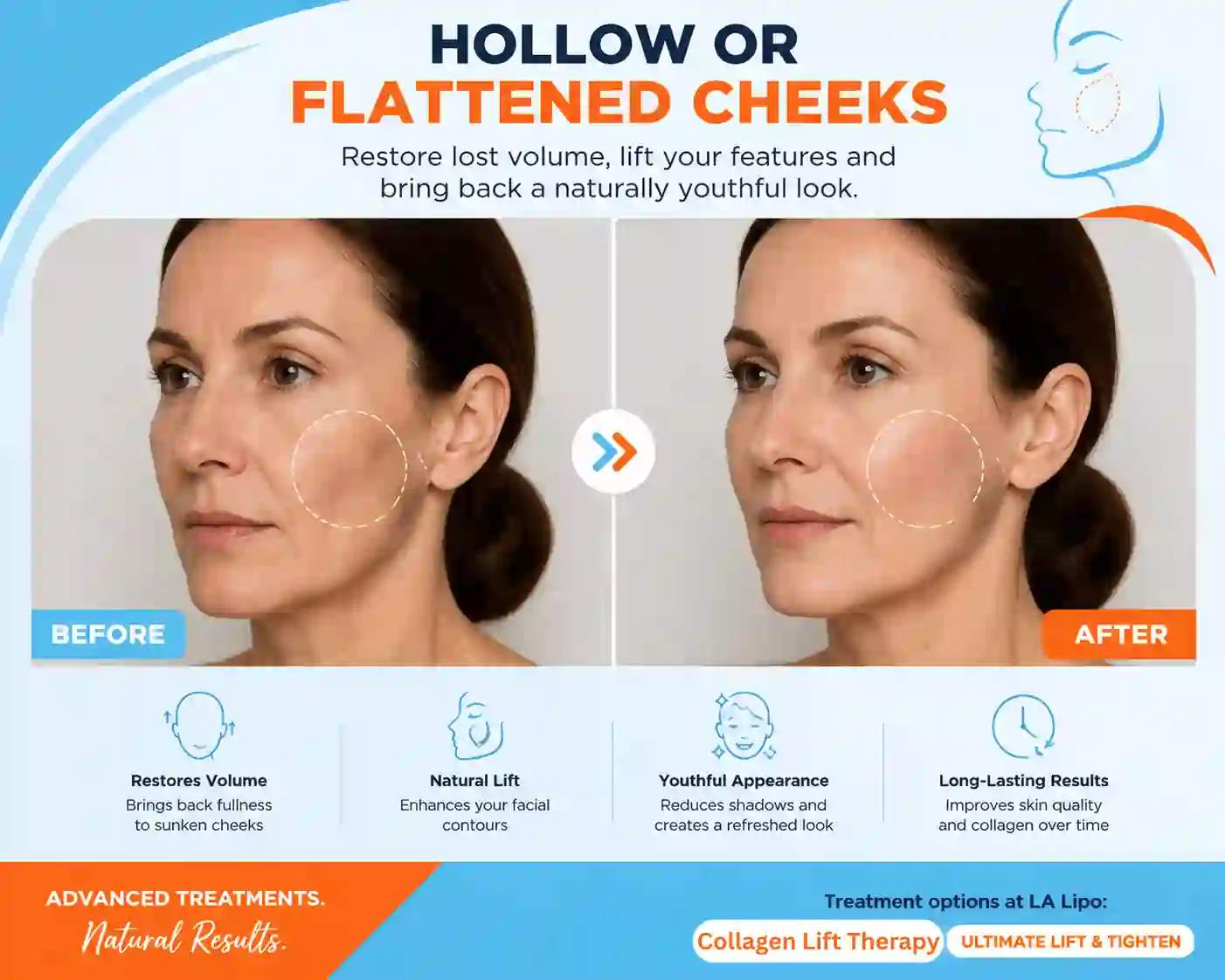 Sign #4: Hollow or Flattened Cheeks Mansfield
