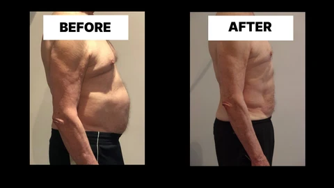 What Symptoms Can Diastasis Recti Cause in Men? Weak Core, Back Pain and Poor Posture Mansfield